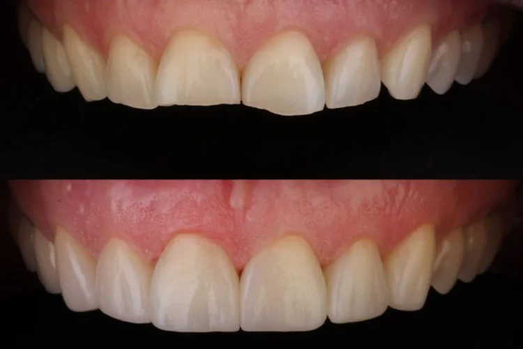 Gros plan sur l'usure dentaire des dents supérieures et inférieures restaurées à l'aide de facettes et de composite.