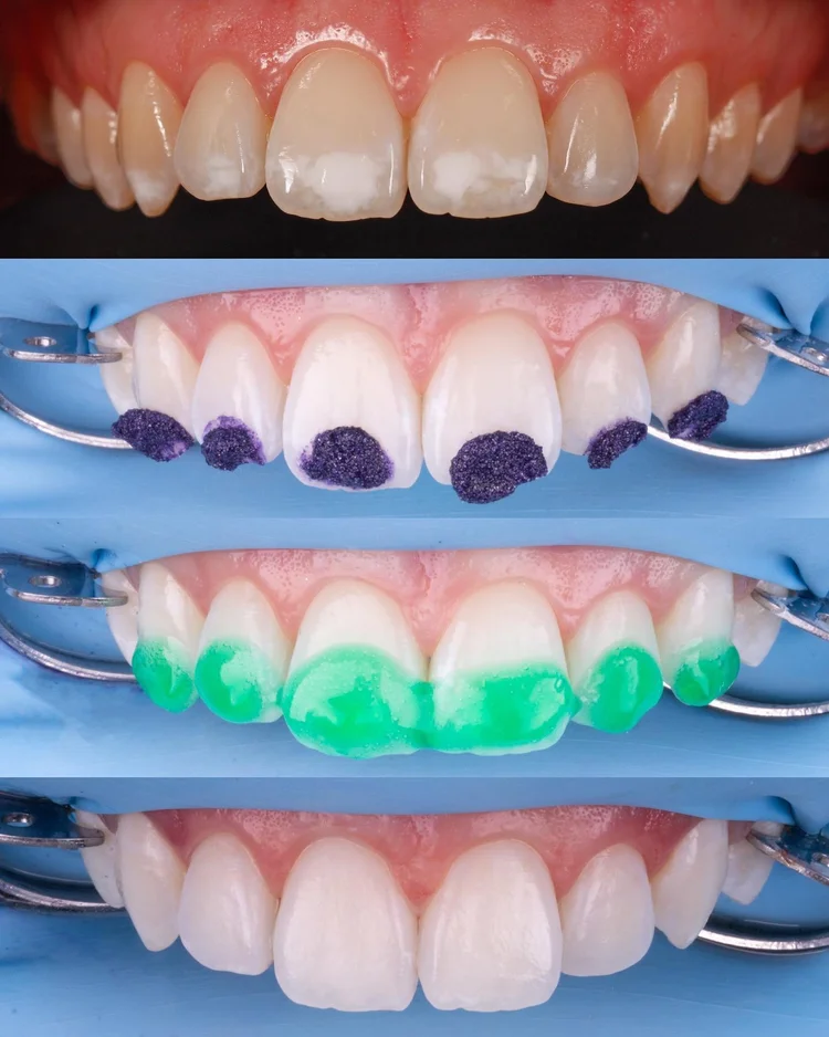 Image d'un traitement des dents décolorées avec le traitement ICON par le dentiste dans un cabinet dentaire à Amsterdam Est.