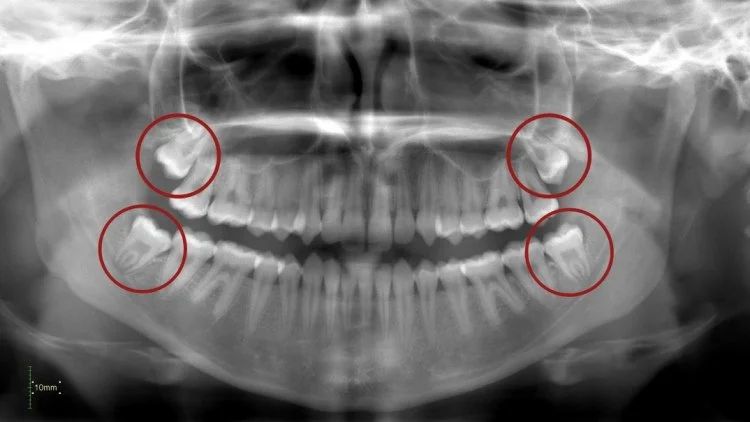 Radiographie des dents de sagesse avant extraction dentaire