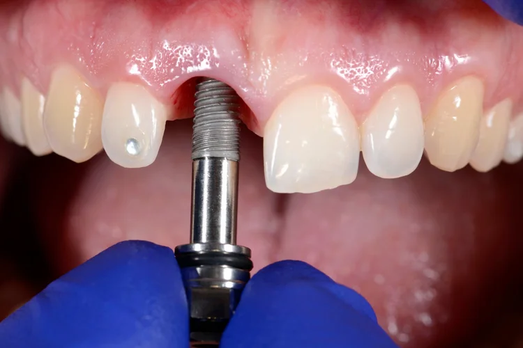Gros plan sur une personne recevant un implant dentaire, par un dentiste implantologue à Amsterdam