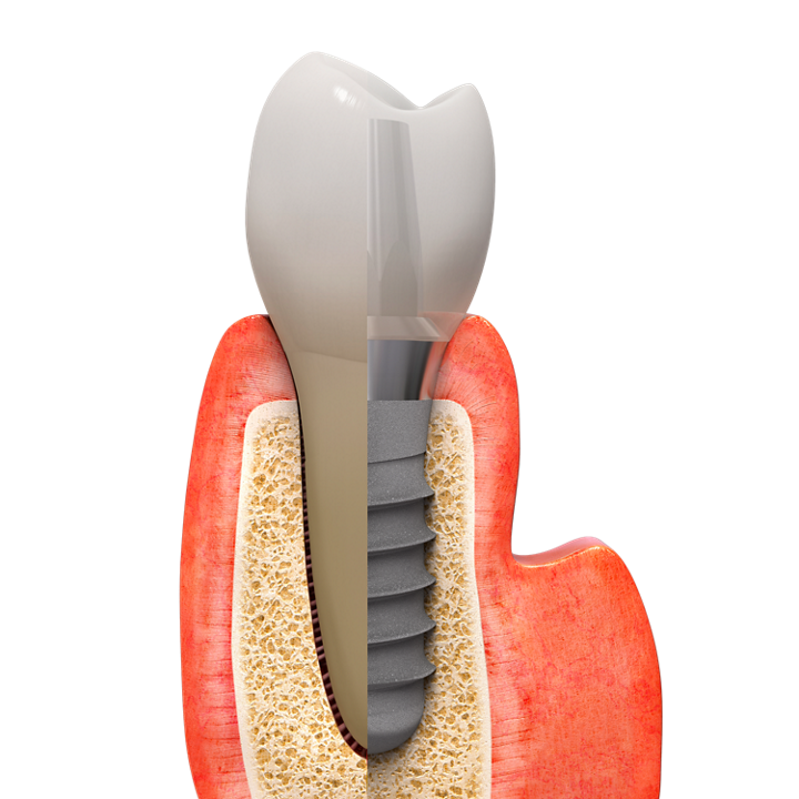 Abbildung eines Zahnimplantats, einschließlich Zahn, Zahnwurzel und Knochengewebe.